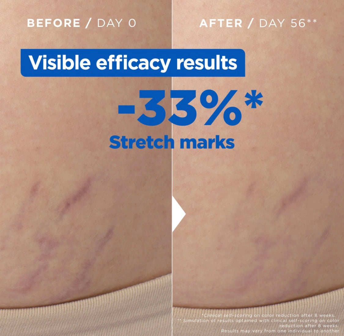 Mixa Anti-Strech Marks Oil with Omega 6 & 9
