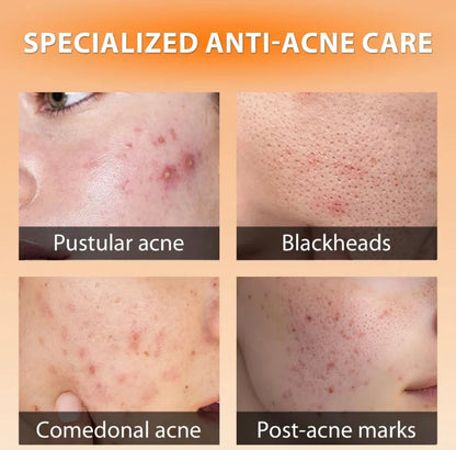 Skinoren 20% Azaleic Acid Cream