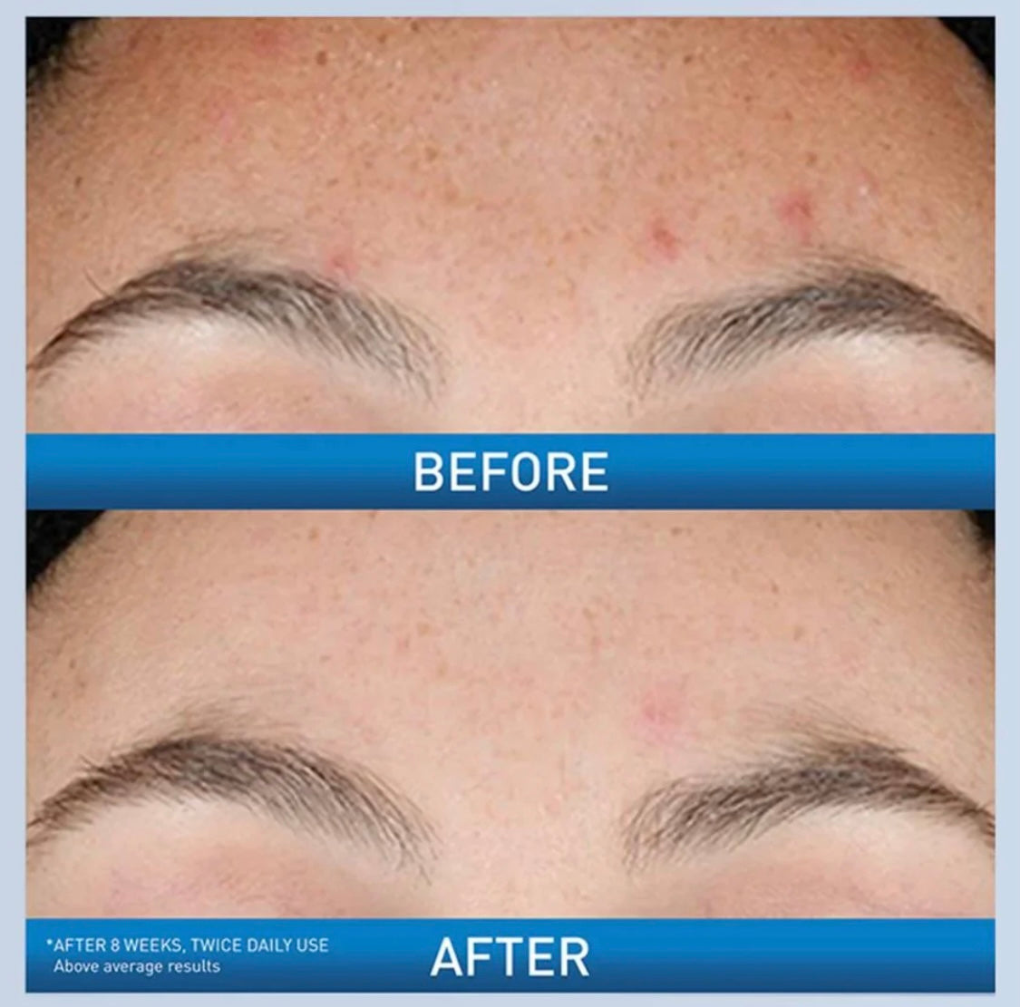 CeraVe Resurfacing Retinol Serum – Gentle Skin-Smoothing Treatment for Post-Acne Marks