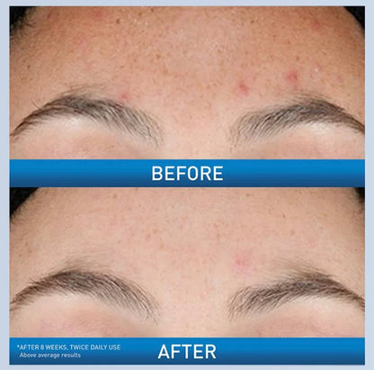 CeraVe Resurfacing Retinol Serum – Gentle Skin-Smoothing Treatment for Post-Acne Marks