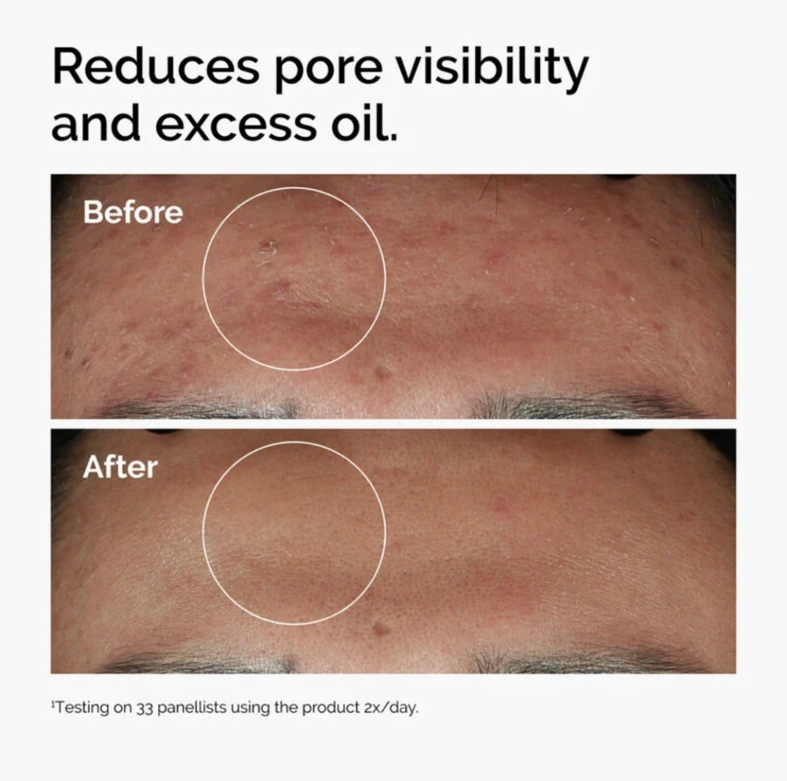 The Ordinary Niacinamide 10% +Zn 1% Hydrating and Oil Control Serum for Oily Skin