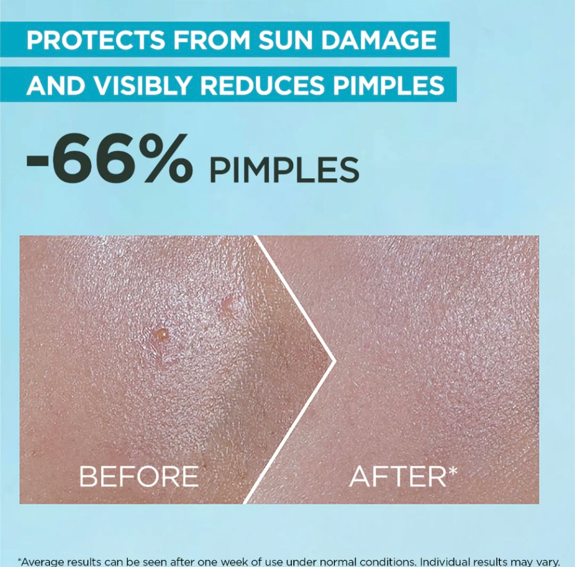 Garnier Super UV Anti-Acne Sunscreen SPF 50 30ml – 12H Oil Control Face Sunscreen for Oily & Acne-Prone Skin