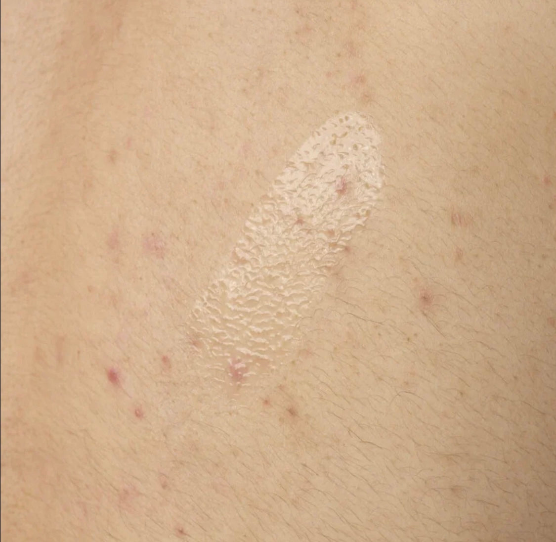 The Ordinary Salicylic Acid 0.5% Body Serum – Exfoliating Acne Treatment for Body & Back